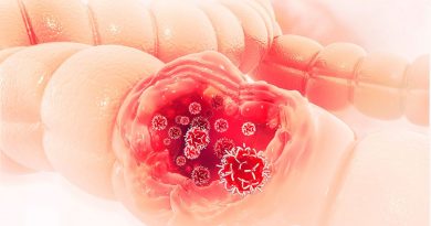 Detección y diagnóstico del cáncer de colon Detección y diagnóstico del cáncer de colon